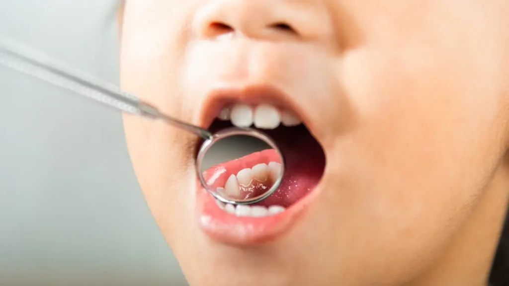 Plano detalle de una boca de un niño para buscar si hay caries en un diente de leche.
